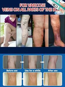 Varicose Vein  Effective Varicose Vein Relief  Relieves Vasculitis Spider Vein Treatment Foot Care Tool - 1 CÁI - Xem 3
