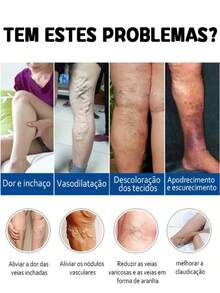 Varicose Vein  Effective Varicose Vein Relief  Relieves Vasculitis Spider Vein Treatment Foot Care Tool - 1 CÁI - Xem 2