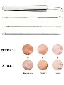 Four-Piece Slanted-Tip Stainless Steel Blackhead Remover Set, Pimple Extractor, Acne Remover, Blackhead And Whitehead Remover, Medical-Grade Acne Treatment Tool, Face, Nose And T-Zone Blemish Removal Kit, Suitable For Blackheads, Pimples, Whiteheads, Acne And Blemishes.