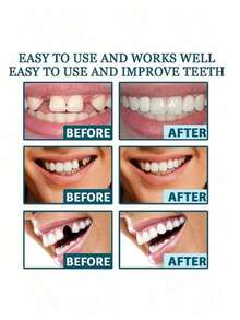 Bộ 2 miếng niềng răng thẩm mỹ Instant Smile, mặt dán sứ trên và dưới dành cho nam và nữ, dễ dàng lắp đặt, không cần dùng lực, hoàn hảo cho trang phục thường ngày - trắng - Xem 4