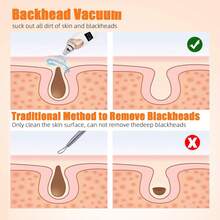电动黑头去除器，面部毛孔清洁器，鼻部黑头吸出器，最佳黑头真空清洁套装，美容仪 - 彩色 - 查看 3