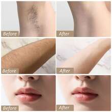 OMCPET IPL Laser Hair Removal For Women And Men, 999,999 Flashes, 5 Levels With Ice Cooling Nearly Painless & Long-Lasting Results Hair Removal Device For Armpits Legs Arms Bikini Line - US A Type Plug(110-127V) - View 6