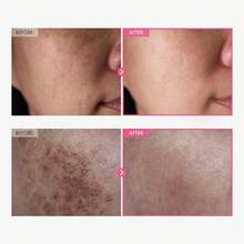 TOSOWOONG Arbutin 7% + Tranexamic Acid 4% Cream, 70,000ppm Arbutin, 40,000ppm TXA, Niacinamide, Glutathione, Dark Spots, Freckle, Blemishes, Pigmentation, Korean Skin Care, 50ml, 1.69 Fl.Oz. - 熊果素7%+氨甲環酸4%乳膏 - 查看 2