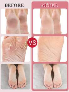 5双装足部去角质面膜，玫瑰足部去角质去角质，去除死皮并滋润护理，不含酒精，富含透明质酸和甘油，缓解干燥皲裂的脚后跟，软化粗糙的足部SPA袜，秋冬季皲裂足部护理，圣诞礼盒装（男女通用）