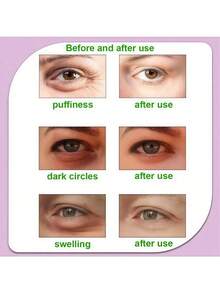 Gel Ice Pack Reusable Cooling Eye Pads And Under Eye Patches, Eye Hot Cold Pack For Eye Rela(2watermelon) - Burgundy - View 6