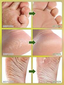 5双装足部去角质面膜 - 蕴含乳酸、尿素和苹果酸，具有去角质、保湿和滋养功效，软化足部粗糙的米色肌肤，令双足丝滑柔嫩 - 精华袜，足部护理，滋养去角质面膜，必备足部护理用品，修脚配件，天然牛油果和芦荟成分，保湿足膜，去除足部死皮 - 白色 - 查看 3