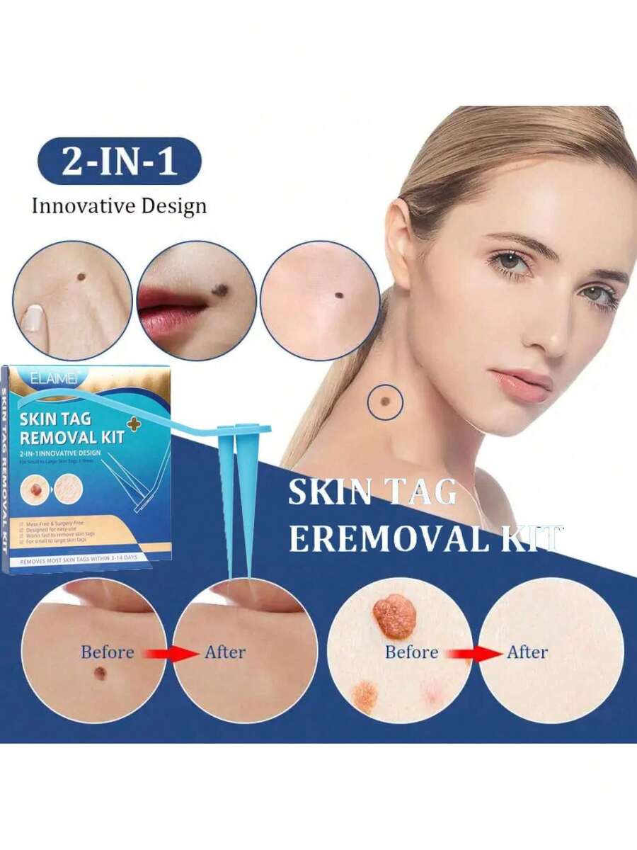 2In1 Auto Skin Warm Removal Kit Painless Mole Wart Remover Equipment Micro Skin Warm Treatment Easy To Clean Skin Care - 1件 - 查看 1