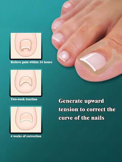100pcs Painless Ingrown Toenail Corrector, Improve Ingrown Nail & Nail Groove Inflammation, Suitable For Foot Care, Suitable For Men And Women Daily Use