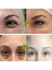 Fat Granules Remover Eye Cream Effective Remove Fat Granules Puffiness Anti-Particles Milia Remover Product Repair Eye Skin Care - 1pcs - 查看 4
