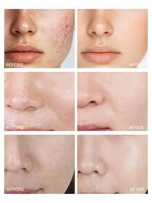 LA ROCHE-POSAY Salicylic Acid Acne Treatment Serum 30ml - 30毫升 - 查看 9