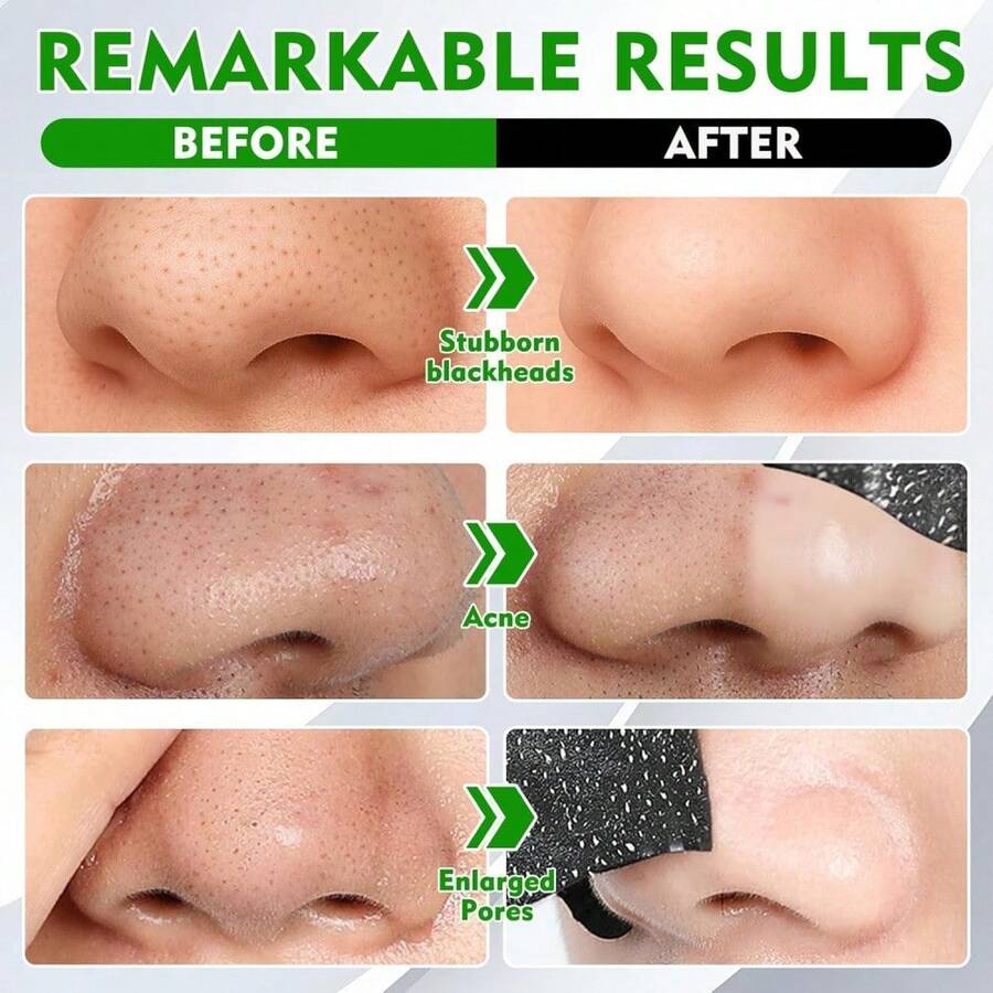 One Pack Contains 5 Strips Of Blackhead Removal Nose Strips, Blackhead Removal Pore Strips, Deep Pore Cleansing, Bamboo Charcoal Facial Strips, Blackhead Pore Strips, Deep Cleansing Charcoal Strips, Blackhead Nose Strips, Suitable For All Skin Types, Suitable For Men And Women - Deep Cleansing Charcoal Strips - Blackhead Nose Strips. - 黑色 - 查看 1