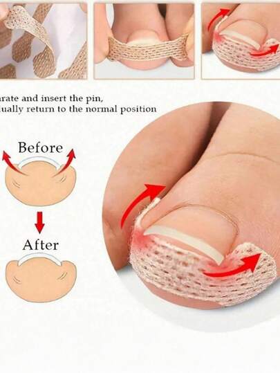 10/20/30/40/50/60/70/80/90/100pcs/Set Ingrown Toenail Correction Patch, Painless Improvement For Ingrown Nail Troubles, Toenail Corrector Suitable For Various Foot Care Types