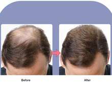 G4 Micro Needle Roller 1200 Needles Stainless Steel 0.5MM Needle Roller for Scalp Care - Blanco - Ver 5