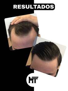 MINOXTURBO Original Hair Growth Shampoo Anti-Hair Loss 240ml - màu đen - Xem 9