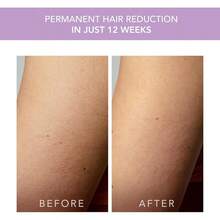 FOREO PEACH 2 Go IPL Depiladora Luz Pulsada - Alternativa para Depiladora Láser Mujer y Hombre Facial y corporal Rápido e indoloro Lavander - Multicolor - Ver 5