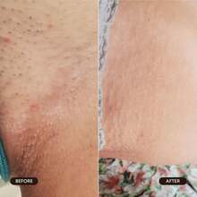 3-Piece Set,Razor Bump Stopper Roll-On, Dark Spot Remover & Ingrown Hair Treatment For Men & Women, No Bump After Shave Serum For Bikini, Face, Neck, Underarms & Legs-Valentines Gifts,Birthday,Gifts For Women,Mardi Gras - 淺藍色 - 查看 6