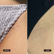 3-Piece Set,Razor Bump Stopper Roll-On, Dark Spot Remover & Ingrown Hair Treatment For Men & Women, No Bump After Shave Serum For Bikini, Face, Neck, Underarms & Legs-Valentines Gifts,Birthday,Gifts For Women,Mardi Gras - 淺藍色 - 查看 7