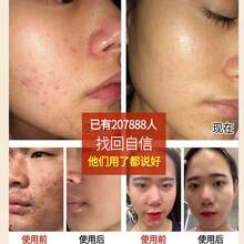 Crema Herbal para el Acné Tratamiento Purificante del Acné Reparación de Cicatrices de Acné Crema para Cicatrices de Acné Crema - Crema potente para el acné 1000 g - Ver 3