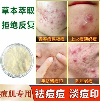 Crema Herbal para el Acné Tratamiento Purificante del Acné Reparación de Cicatrices de Acné Crema para Cicatrices de Acné Crema