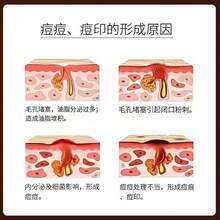 Crema Herbal para el Acné Tratamiento Purificante del Acné Reparación de Cicatrices de Acné Crema para Cicatrices de Acné Crema - Crema potente para el acné 1000 g - Ver 5