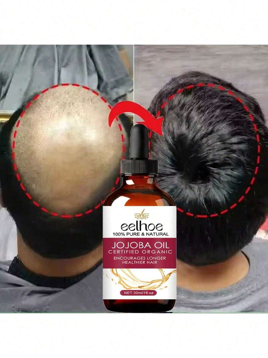 Reduce Loss Scalp Treatment More Thicker Keep Regrowth Oil Control Hair Nourish Essencial Oi - 1 Item - View 1