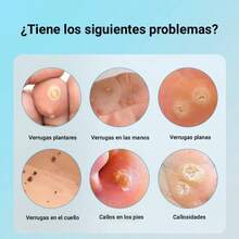 30ml/60ml de acción rápida para eliminar verrugas, con ácido salicílico, apto para todas las partes del cuerpo, para verrugas planas, verrugas comunes,duofilm verrugas,verrugas plantares y callos, fórmula suave, imprescindible para familiares y amigos, vale la pena usarlo de forma continua y es un gran regalo - Masaje de cuello - Ver 3