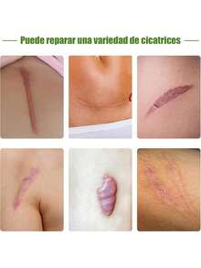EstiloTendenciaParche De Silicona Para Cicatrices, Parches Silicona Cicatrices, Silicone Scar Sheets,1.5M Cinta De Silicona Para Cicatrices Para Todo Tipo De CicatricesCalidad PremiumVersióN Mejorada - 1 artículo - Ver 3
