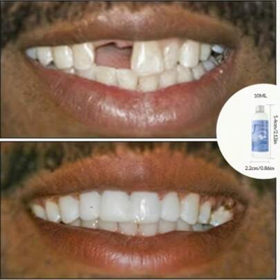 Tandklämma i harts - Enkel gör-det-själv-tanddekoration för fester, bröllop, alla hjärtans dag, karnevaler, festtillbehör och enkla fyllningstillbehör, justerbara löständer - realistisk och bekväm passform, förbättrar leendet naturligt, lämplig för män och kvinnor, vardagskläder och speciella tillfällen, perfekt present till självförtroende - prisvärd tandlösning, självförtroendebooster, realistiska tänder, lätt känsla, självvårdsentusiaster, present till honom eller henne