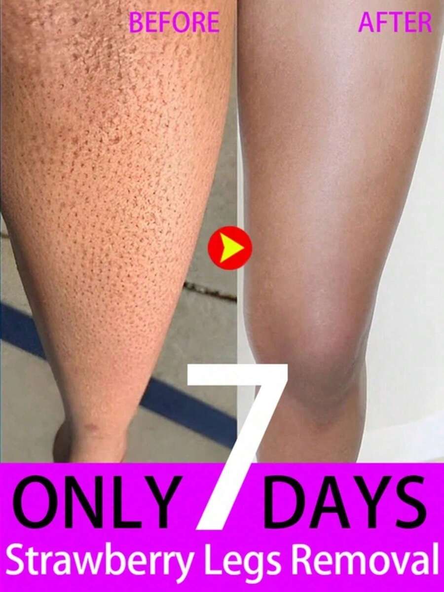 Strawberry Legs Removing Cream For Keratosis Pilaris Skincare Lotion - 1 mặt hàng - Xem 1