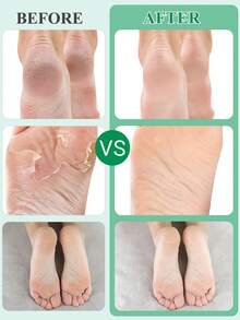 5双装足部去角质面膜，荷荷巴油足部去角质去角质，去除死皮并保湿护理，不含酒精，富含透明质酸和甘油，缓解干燥皲裂的脚后跟，软化粗糙的足部SPA袜，皲裂足部去角质面膜（男女通用） - 白色 - 查看 5