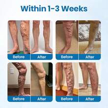 2025 Hot Selling Blue Light Vein Tool, Say Goodbye To Varicose Veins - 1PC - 查看 2