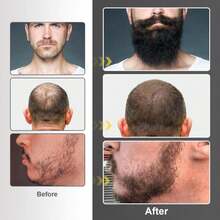Beard Growth Kit - Beard Kit For Men With Beard Growth Oil (2oz), Beard Balm, Beard Comb, Massager For Spot_Patchy Beard - Christmas, Anniversary, Birthday For Men, Dad, Husband, Boyfriend - White - 查看 6