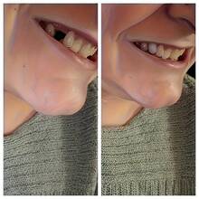 2 Sets Resin Tooth Decorations With Clips - DIY Fake Teeth, Convenient DIY Accessories For Halloween, Party, Wedding, Valentine's Day, Carnival And Simple Tools, Temporary Teeth, Dentures - Multicolor - View 1