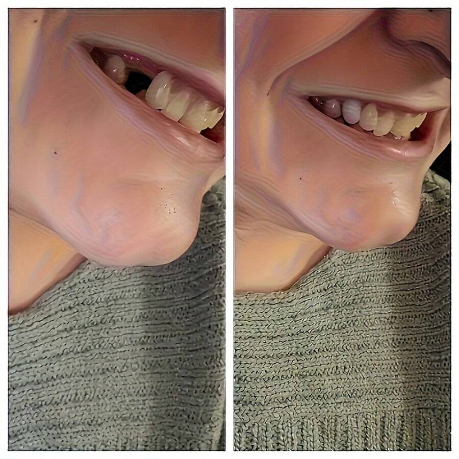 2 Sets Resin Tooth Decorations With Clips - DIY Fake Teeth, Convenient DIY Accessories For Halloween, Party, Wedding, Valentine's Day, Carnival And Simple Tools, Temporary Teeth, Dentures - Multicolor - View 1