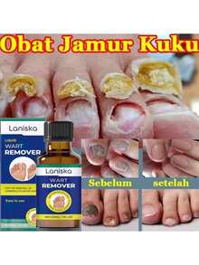 Nail Fungus Treatment Essence Cream Antifungal Gel Anti Infection Onychomycosis Paronychia Nursing - 1 Item - View 7