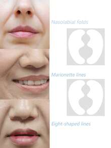 5pcs Anti-Wrinkle Patches To Reduce Lines Around Mouth, Nasolabial Folds And Laugh Lines. They Can Lift And Tighten Facial Skin, Suitable For All Skin Types. Designed To Contour The Face With No Loose Edges, Restoring Skin Elasticity. - Multicolor - View 4