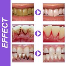 30ml V34 Teeth Whitening Toothpaste Serum, Tooth Colour Corrector Foam Remove Yellow Stains Tartar Oral Hygiene Cleaning Dental Bleaching Tools Fresh Breath Tooth Whitener Care Essence - Teeth Whitening Serum - 查看 6