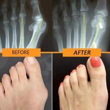 Dispositivo de corrección de hallux valgus, corrector de dedo gordo del pie, espaciador, soporte cómodo y transpirable día y noche, expansor de valgo, alivio del dolor, antideslizante, férula ortopédica para hallux valgus. - Blanco - Ver 8