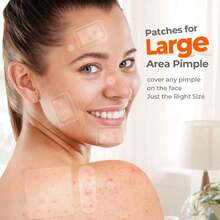 Large Pimple Patches For Face, 7 Sizes Big Acne Patches, FSA Eligible XL Hydrocolloid Bandages For Body, Chin, Forehead, Nose, Blemish Zit Breakouts, Hydrocolloid Patch (Square, Strip, Dot 142 Count) - ColorA - 查看 3