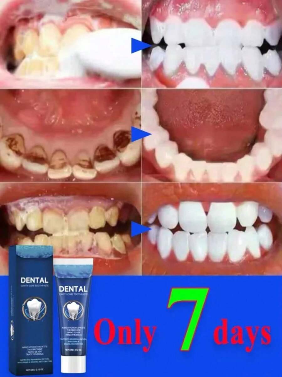 Professional Teeth Whitening Toothpaste With Tartar Control Formula Removes Stubborn Plaque And Yellow Stains For Whiter Teeth A - 1 cái - Xem 1