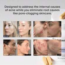 Bestseller!CLEARSTEM - MINDBODYSKIN Hormonal Acne Supplement (5-HTP) - Natural DIM Supplement - Skin Care Vitamins - Hormone Balance, Antioxidants - Gluten Free, Cruelty Free - 30 Servings, 90 Capsules.Supplement Vitamin,Free Shipping. - 3件 - 查看 11
