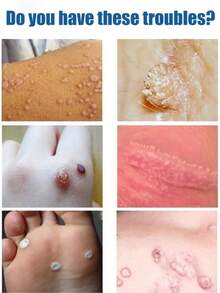 And They Will Fall Off Naturally In 7 Days Without Leaving Any Marks - Pack Of 1Pcs - View 3