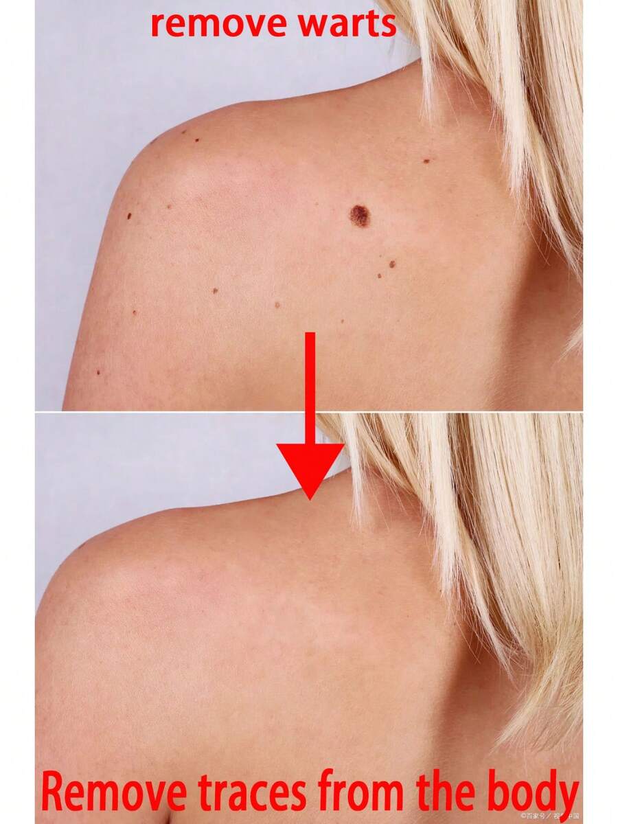 And They Will Fall Off Naturally In 7 Days Without Leaving Any Marks