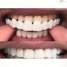 2pcs/Set Soft White Comfortable Tooth Veneers, Smile Dental Covers, Includes Upper And Lower Rows, Unisex Easy To Wear Tooth Concealing Solution, Boost Confidence, Temporary Cosmetic Tooth Covers, Universal Tooth Defect Repair Veneers - White - View 5