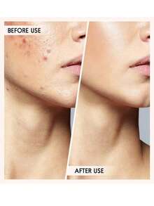 4pcs/Set Blackhead Remover, Stainless Steel Acne Tool Kit, Nose & Face Acne Extractor - Multicolor - View 7