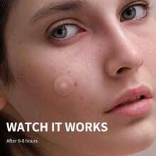 720/360/144片装祛痘贴，疤痕遮盖贴，含镊子，无菌卫生，温和不刺激，不含酒精 - 彩色 - 查看 4