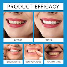 Kit de luz LED para blanqueamiento dental profesional con gel blanqueador 4X y sistema de blanqueamiento acelerado con luz azul para una sonrisa blanca. - Blanco - Ver 9