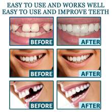 一套便携式牙齿装饰品，包括可拆卸牙贴面、临时上下假牙，适合所有缺牙的朋友，也可作为宴会/派对期间的临时牙齿配件，是送给父母/情人节的完美礼物。 - 白色 - 查看 3