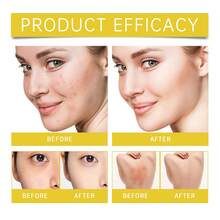 Acne-Prone Skin Care Set: Suitable For Acne-Prone Skin, Providing Gentle Hydration And Moisturizing. - 痘肌保養套裝 - 查看 6