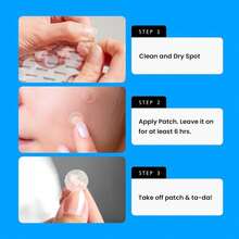 AVARELLE Acne Cover Patches, Eligible Hydrocolloid Pimple Patches For Face With Tea Tree Oil, Korean Skincare Zit Patches For Face | HSA Store Eligible Items | Vegan, Cruelty-Free - MàuB - Xem 7